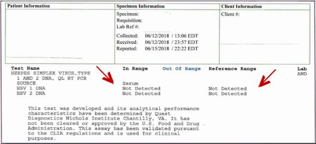 Herpes Testimonials Scalar Light