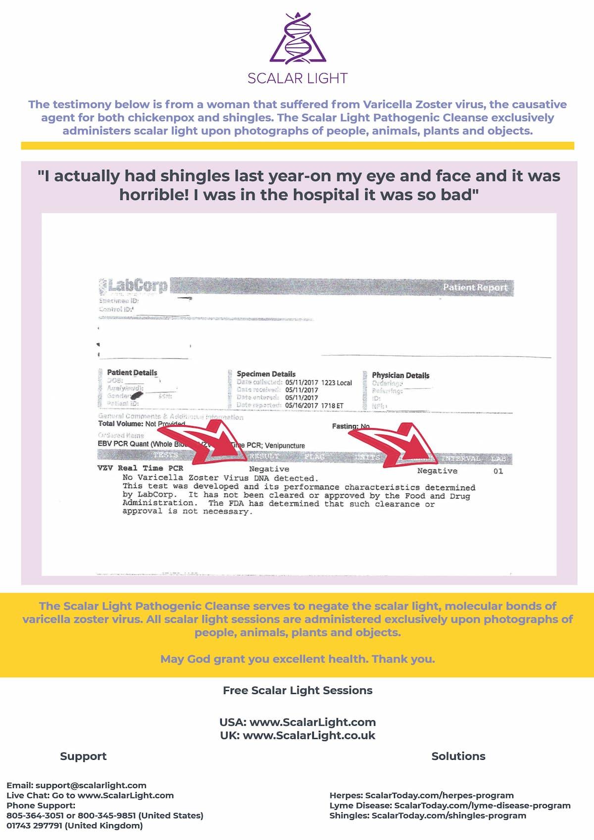 Shingles PCR Test Result